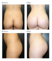 Brazilian Butt Lift with Dr. Kenneth Hughes