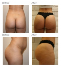 Brazilian Butt Lift with Dr. Kenneth Hughes