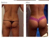 Brazilian Butt Lift with Dr. Kenneth Hughes