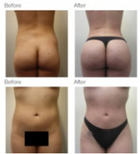 Brazilian Butt Lift with Dr. Kenneth Hughes