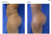 Brazilian Butt Lift with Dr. Kenneth Hughes