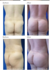 Brazilian Butt Lift with Dr. Kenneth Hughes