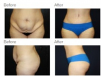 Tummy Tuck Los Angeles with Dr. Kenneth Hughes