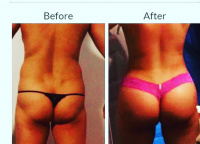 Liposuction and Brazilian buttlift Los Angeles with Dr. Kenneth Hughes