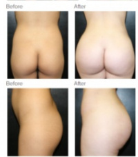 Liposuction with Dr. Kenneth Hughes