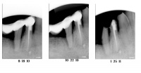 periodontium regeneration