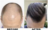 Hair Transplant Before and After Photo