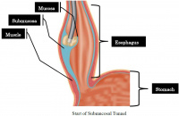 achalasia and POEM procedure