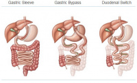 gastric bypass