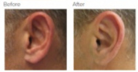 Ear Correction Los Angeles with Dr. Kenneth Hughes