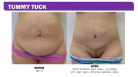 Actual Patient Tummy Tuck