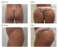 Butt Implants with Dr. Kenneth Hughes