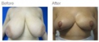 Breast Reduction Los Angeles with Dr. Kenneth Hughes