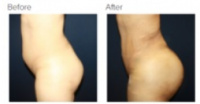 Liposuction Revision & Cellulite Reduction Los Angeles with Dr. Kenneth Hughes