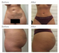 Liposuction with Dr. Kenneth Hughes