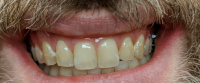 Glo whitening before
