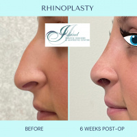 Rhinoplasty (Nose Job)