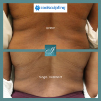 CoolSculpting