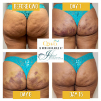 Qwo Cellulite Injections