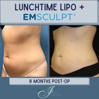 Lunchtime Lipo + Emsculpt