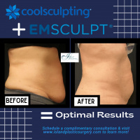 CoolSculpting + Emsculpt