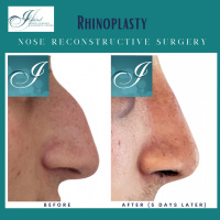 Rhinoplasty