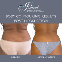 Liposuction