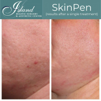 SkinPen