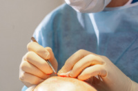 Hair restoration