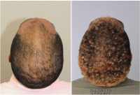 One year out from 1847 FUE hair transplant grafts.