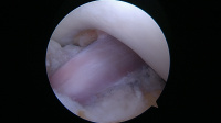 Anatomic Bone-Patellar Tendon-Bone Anterior Cruciate Ligament (ACL) Reconstruction