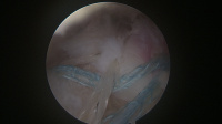 Arthroscopic Double Row Rotator Cuff Repair improves pain, healing, and function.