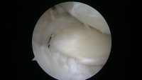 Medial meniscus posterior root repair restores meniscal function and prevents rapid onset arthritis.