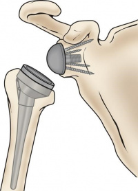 Reverse shoulder replacement