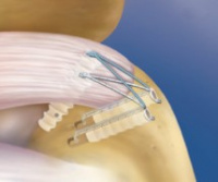 Rotator Cuff Repair