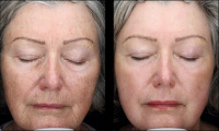 Laser resurfacing