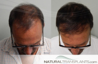 Best Hair Transplant