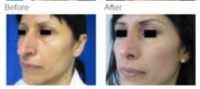 Rhinoplasty Los Angeles with Dr. Kenneth Hughes