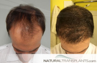 Hair Transplant Surgery