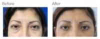 Eyelid Surgery Los Angeles with Dr. Kenneth Hughes