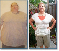 weight-loss surgery.