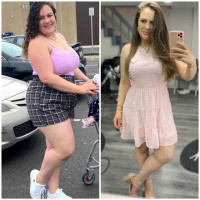 weight-loss surgery.