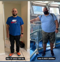 weight-loss surgery.