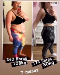 weight-loss surgery.