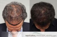 Hair Transplant Cost