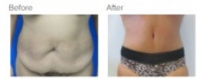 Tummy Tuck Los Angeles with Dr. Kenneth Hughes