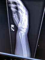 Wrist Fracture