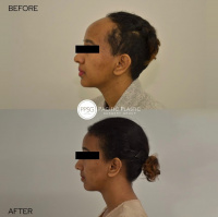 Facelift Surgeon