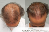 Hair Transplant Results