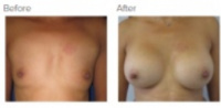 Breast Augmentation (Implants) Los Angeles with Dr. Kenneth Hughes